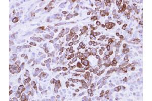 IHC-P Image MX1 Antobody detects MX1 protein at cytosol on MDA-MB-468 xenograft by immunohistochemical analysis. (MX1 anticorps  (Center))
