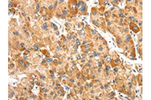 The image on the left is immunohistochemistry of paraffin-embedded Human liver cancer tissue using ABIN7192438(SLC24A6 Antibody) at dilution 1/20, on the right is treated with synthetic peptide. (SLC24A6 anticorps)