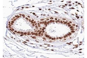 ABIN6267625 at 1/100 staining human Breast carcinoma tissue sections by IHC-P.