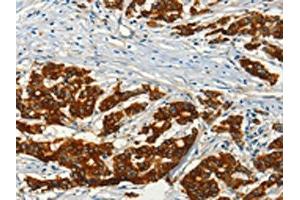 The image on the left is immunohistochemistry of paraffin-embedded Human colon cancer tissue using ABIN7128251(ADCY3 Antibody) at dilution 1/50, on the right is treated with fusion protein. (ADCY3 anticorps)
