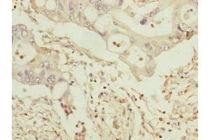 Immunohistochemistry of paraffin-embedded human pancreatic cancer using ABIN7159917 at dilution of 1:100 (TOMM34 anticorps  (AA 1-309))