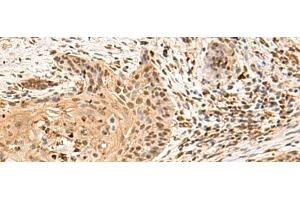 Immunohistochemistry of paraffin-embedded Human esophagus cancer tissue using PTH1R Polyclonal Antibody at dilution of 1:65(x200) (PTH1R anticorps)