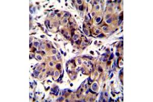 Immunohistochemistry (Formalin/PFA-fixed paraffin-embedded sections) of human breast cancer tissue withMAGEA3 polyclonal antibody . (MAGEA3 anticorps  (AA 283-314))