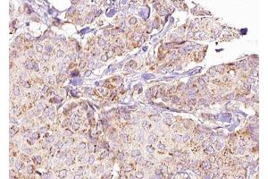 ABIN6276290 at 1/100 staining Human breast cancer tissue by IHC-P.