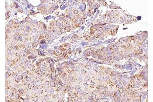 ABIN6276290 at 1/100 staining Human breast cancer tissue by IHC-P. (ATG5 anticorps  (C-Term))