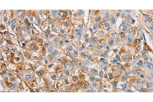 Immunohistochemistry of paraffin-embedded Human liver cancer tissue using IKK gamma Polyclonal Antibody at dilution 1:60
