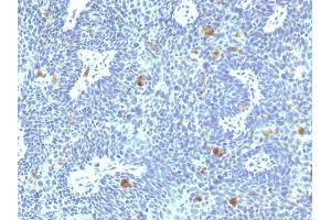 Formalin-fixed, paraffin-embedded human Cervix stained with HPV-16 Mouse Monoclonal Antibody (HPV16/1295). (HPV16 anticorps)