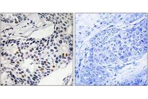 Immunohistochemistry analysis of paraffin-embedded human breast carcinoma, using WEE1 (Phospho-Ser53) Antibody. (WEE1 anticorps  (pSer53))