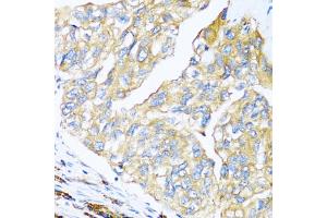 Immunohistochemistry of paraffin-embedded human prostate cancer using MANF antibody (ABIN6291535) at dilution of 1:100 (40x lens). (MANF anticorps)