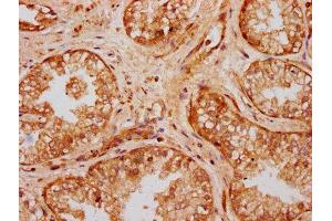 IHC image of ABIN7175133 diluted at 1:300 and staining in paraffin-embedded human prostate cancer performed on a Leica BondTM system. (UMODL1 anticorps  (AA 537-654))