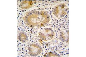 Formalin-Fixed, Paraffin-Embedded human colon carcinoma tissue reacted with Autophagy APG16L antibody (C-term), which was peroxidase-conjugated to the secondary antibody, followed by DAB staining. (ATG16L1 anticorps  (C-Term))