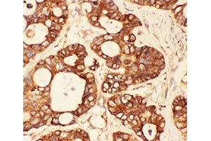 IHC-P: Src antibody testing of human intestinal cancer tissue (Src anticorps  (AA 2-368))