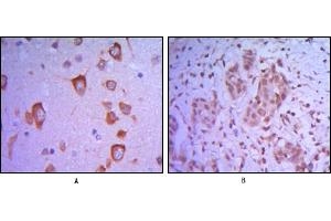 Immunohistochemical analysis of paraffin-embedded human brain tissue (A) and breast tumor (B) uing ETS1 mouse mAb.