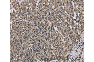 Immunohistochemistry of Human breast cancer using DCTN4 Polyclonal Antibody at dilution of 1:30 (Dynactin 4 anticorps)