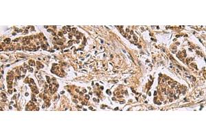 Immunohistochemistry of paraffin-embedded Human breast cancer tissue using DNA2 Polyclonal Antibody at dilution of 1:40(x200) (DNA2 anticorps)