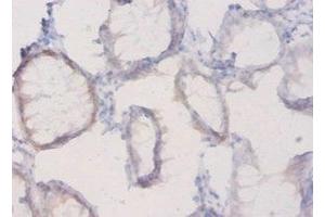 Immunohistochemistry of paraffin-embedded human colon cancer using ABIN7163695 at dilution of 1:20 (Plexin A1 anticorps  (AA 32-296))