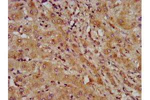 IHC image of ABIN7158792 diluted at 1:600 and staining in paraffin-embedded human liver cancer performed on a Leica BondTM system. (LAPTM4B anticorps  (AA 174-226))