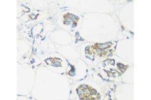 Immunohistochemistry of paraffin-embedded Human mammary cancer using NMT1 Polyclonal Antibody at dilution of 1:100 (40x lens). (NMT1 anticorps)