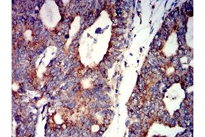 Immunohistochemical analysis of paraffin-embedded rectum cancer tissues using CHRNA7 mouse mAb with DAB staining.