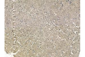 ABIN6256505 and ABIN6267159 at 1/100 staining human hepatocellular carcinoma by IHC-P.