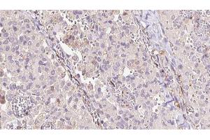 ABIN6273313 at 1/100 staining Human thyroid cancer tissue by IHC-P.