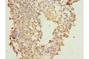 Immunohistochemistry of paraffin-embedded human breast cancer using ABIN7145623 at dilution of 1:100