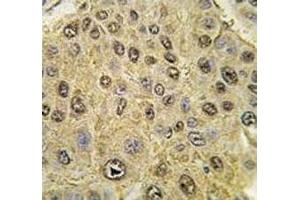 IHC analysis of FFPE human hepatocarcinoma tissue stained with HIF-1 alpha antibody