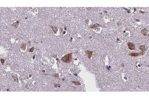 ABIN6276299 at 1/100 staining Human brain cancer tissue by IHC-P.