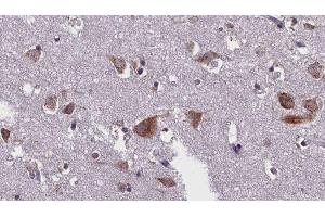 ABIN6276299 at 1/100 staining Human brain cancer tissue by IHC-P. (Caspase 10 anticorps)