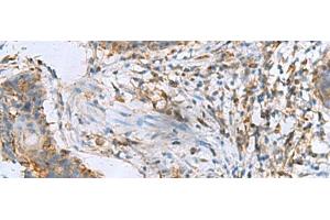Immunohistochemistry of paraffin-embedded Human esophagus cancer tissue using RPL10A Polyclonal Antibody at dilution of 1:50(x200) (RPL10A anticorps)