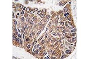 IHC analysis of FFPE human lung carcinoma tissue stained with AKT2 antibody