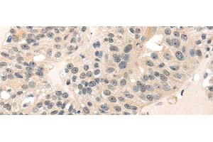 Immunohistochemistry of paraffin-embedded Human breast cancer using MED28 Polyclonal Antibody at dilution of 1/30 (MED28 anticorps)