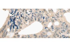 Immunohistochemistry of paraffin-embedded Human colorectal cancer tissue using ETV4 Polyclonal Antibody at dilution of 1:25(x200) (ETV4 anticorps)