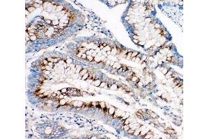 IHC-P: IGF2R antibody testing of human intestine cancer tissue (IGF2R anticorps  (C-Term))