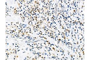 ABIN6258629 and ABIN6275742 at 1/100 staining Human esophageal cancer by IHC-P. (Elf4 anticorps  (Internal Region))