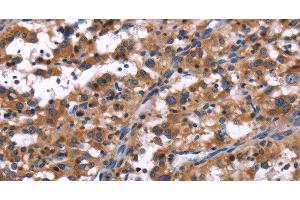 Immunohistochemistry of paraffin-embedded Human thyroid cancer tissue using R3HCC1L Polyclonal Antibody at dilution 1:40 (GIDRP88 anticorps)