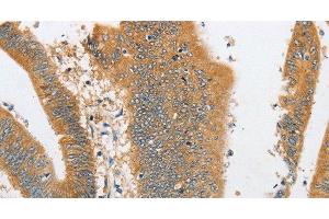 Immunohistochemistry of paraffin-embedded Human colon cancer tissue using ARHGAP5 Polyclonal Antibody at dilution 1:30 (ARHGAP5 anticorps)