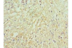 Immunohistochemistry of paraffin-embedded human glioma using ABIN7157975 at dilution of 1:100 (Leiomodin 1 anticorps  (AA 29-187))