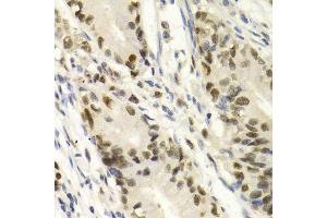 Immunohistochemistry of paraffin-embedded human gastric cancer using KPNA4 Antibody.