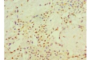 Immunohistochemistry of paraffin-embedded human breast cancer using ABIN7170704 at dilution of 1:100