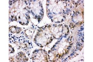 IHC-P: MCM5 antibody testing of human intestinal cancer tissue (MCM5 anticorps  (C-Term))