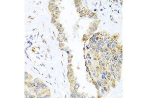Immunohistochemistry of paraffin-embedded human lung cancer using DARS2 antibody. (DARS2 anticorps  (AA 406-645))
