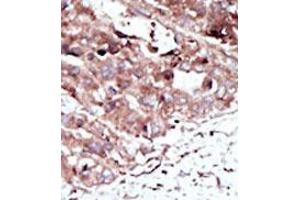 Formalin-fixed and paraffin-embedded human cancer tissue (hepatocarcinoma) reacted with the primary antibody, which was peroxidase-conjugated to the secondary antibody, followed by AEC staining.