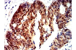 Immunohistochemical analysis of paraffin-embedded rectum cancer tissues using CTNNB1 mouse mAb with DAB staining.
