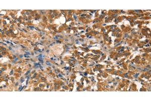 Immunohistochemistry of paraffin-embedded Human thyroid cancer tissue using AGO1 Polyclonal Antibody at dilution 1:40 (AGO1 anticorps)