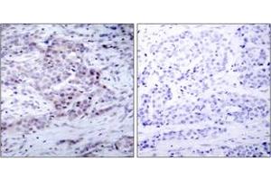 Immunohistochemistry analysis of paraffin-embedded human breast carcinoma, using NF-kappaB p100/p52 (Phospho-Ser869) Antibody. (NFKB2 anticorps  (pSer870))