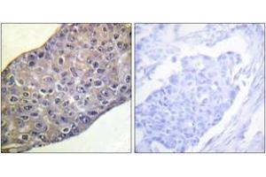 Immunohistochemistry analysis of paraffin-embedded human breast carcinoma tissue, using RhoA (Ab-188) Antibody. (RHOA anticorps  (AA 144-193))