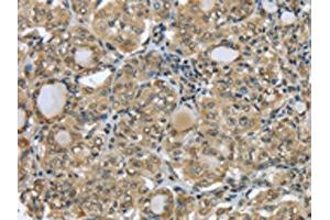 The image on the left is immunohistochemistry of paraffin-embedded Human thyroid cancer tissue using ABIN7131308(TBL1Y Antibody) at dilution 1/20, on the right is treated with fusion protein. (TBL1Y anticorps)