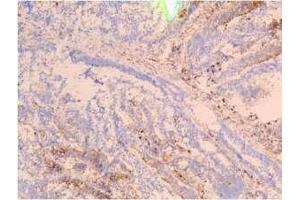 Staining of frozen tissue sections of colon carcinoma using SSEA-4 F8 antibody (Recombinant SSEA-4 anticorps)