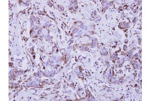 IHC-P Image Immunohistochemical analysis of paraffin-embedded human breast cancer, using Interferon gamma Receptor 1, antibody at 1:250 dilution. (IFNGR1 anticorps)